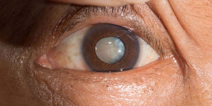 Cataract treatment at all for eyes hospital, vashi, navi mumbai
