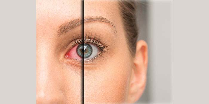 Dry eye treatment at all for eyes hospital, vashi, navi mumbai