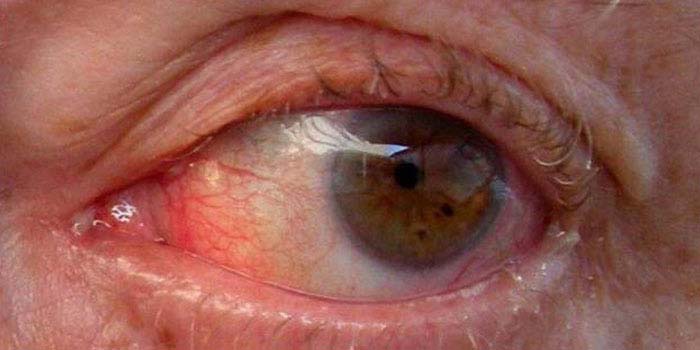 Glaucoma treatment at all for eyes hospital, vashi, navi mumbai