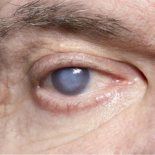 Cataract treatment at All For Eyes Hospital