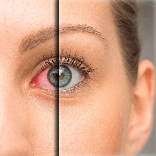 Dry eye treatment at All For Eyes Hospital