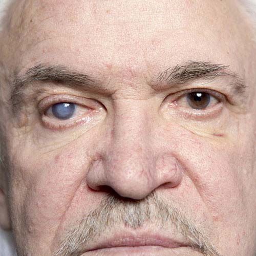 Glaucoma treatment at All For Eyes Hospital