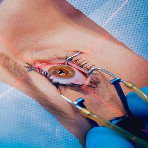 LASIK at All For Eyes Hospital